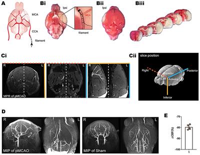 Impaired Glymphatic Transport Kinetics Following Induced Acute Ischemic Brain Edema in a Mouse pMCAO Model